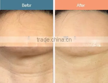 Hair loss treatment 4 in 1 dermaroller, micro rolling system with CE certificate-L013C