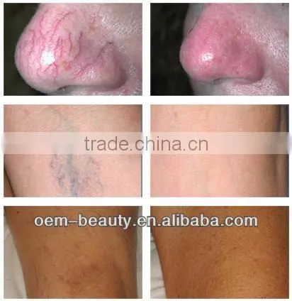 2014 top sale ipl hair removal machine A003 for import