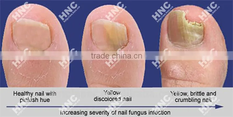 Bulk Buy from China Laser Therapy Devices for Toe Nail Finger Nail Mycotic Infection