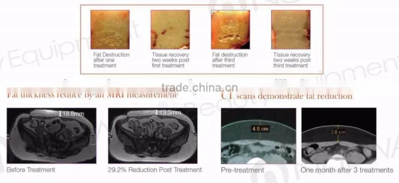 Big promotion ! best slimming product hifu ultrasonic machine price