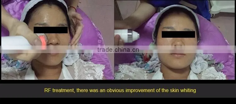 High Quality IPL System elight Painless Hair Removal For Body NS-D12