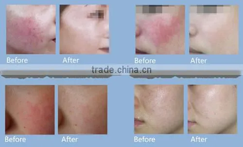 beauty & personal care 980nm diode laser spider vein removal machine vascular remover