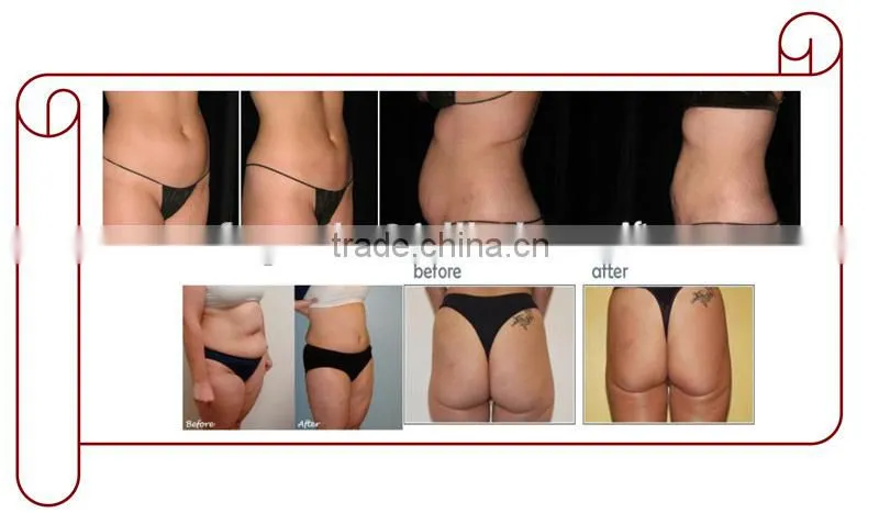 Ultrasonic Cavitation/Cavitation Slimming Machine/Cavitation Machine