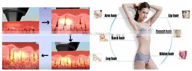 professional 808nm diode laser hair removal machine/ 808nm diode laser for beauty salon/2016 new beauty equipment