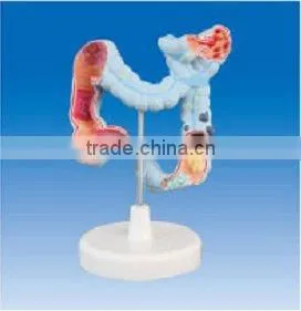 Colon model Pathological model of colon