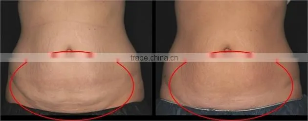 Mini Fat Lipo Freezing Slimming Machine Coolshaping Machine
