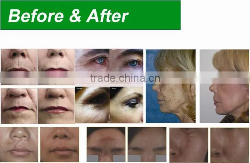 2016 Acne scar removal Co2 fractional laser equipment/rf tube Co2/co2 wart laser/equipo laser co2 fraccionado vaginal