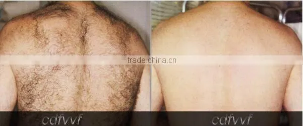 latest technology permanently remove hair machine delight facial hair remover laser facial rejuvenation