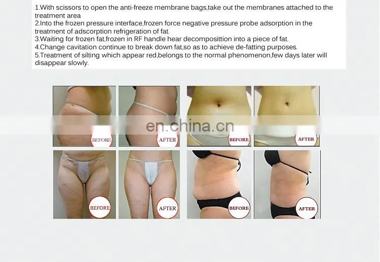 2022 new Item two cryo handles work at the same time 360 Cryo Slimming Machine double chin removal