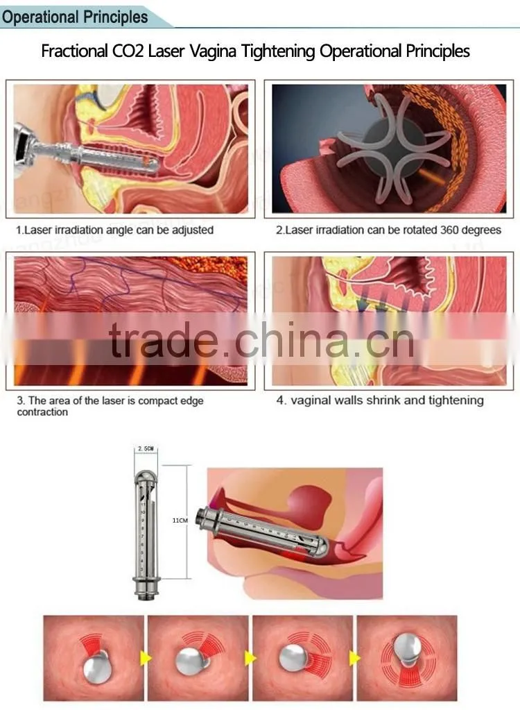 guangzhou vertical farctional co2 laser/co2 laser fractional vaginal tighten machine CE approved
