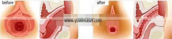 Portable Safety Color Touch Screen vaginal rejuvenation HIFU / HIFU Machine