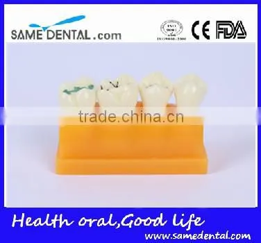 Pit and fissure model Dental Eduction Assitant No. DEA-19