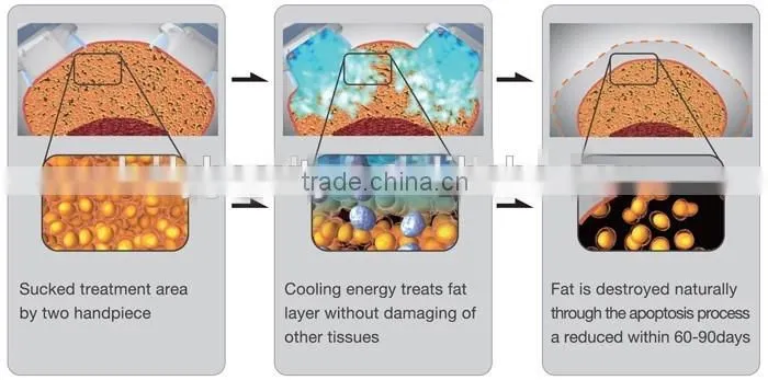 Newest 360-Degree cryolipolysis cool slim fat freezing treatment