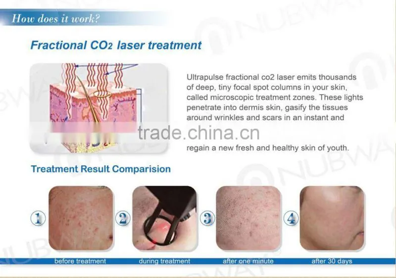 Fractional CO2 Laser Machine for skin resurfacing and scar removal