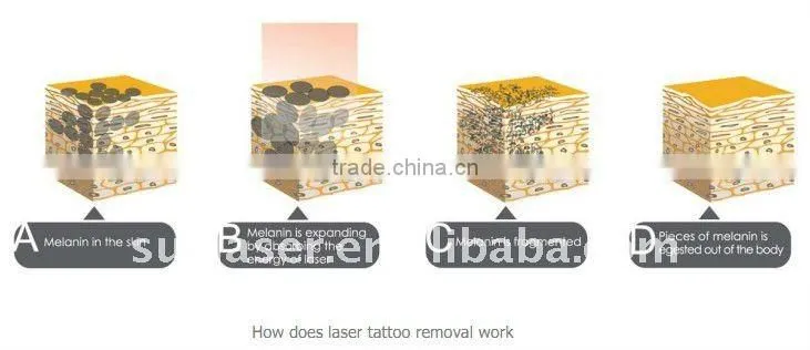 Vertical Q-Switched YAG Laser equipment for Tattoo Removal black head and clean skin