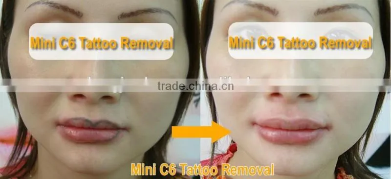 IPL rf nd yag laser hair removal machine / Q switch mini nd yag laser machine