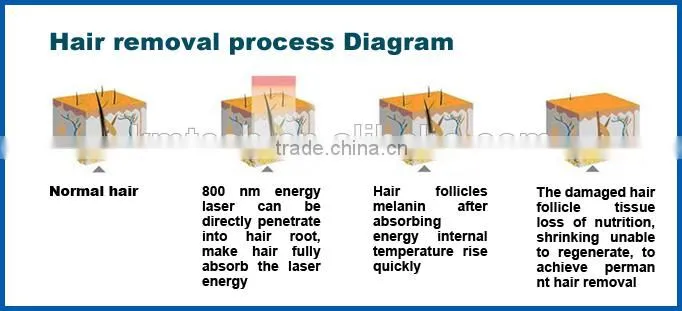 Safety 808nm laser diode hair removal without pain