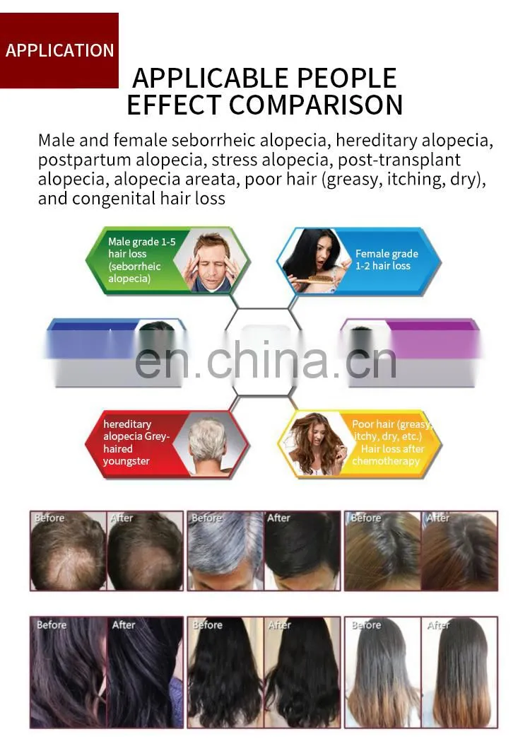 650nm Diode Laser SPA Scalp Treatment Machine with Hair Analysis Camera Professional Hair Regrowth Machine for Hair Salon