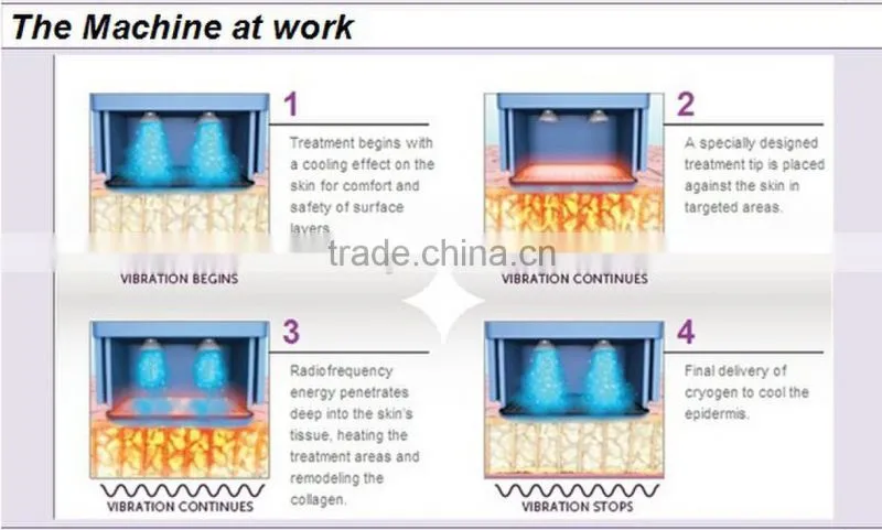 fractional rf lift