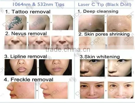 Alibaba express ! Touched screen q-switch laser pigmentation removal (OD-LS600A)