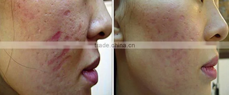 PHOTON DERMA ROLLER (Can change head) L001