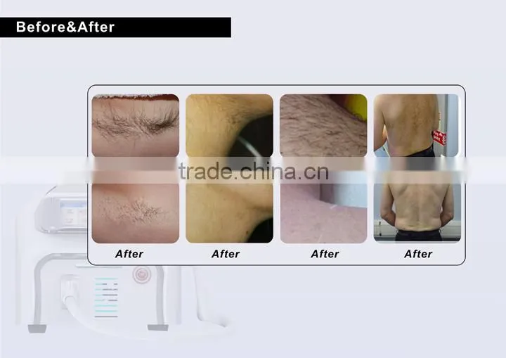 Diode Laser Hair Removal Machine-professional for hair removal