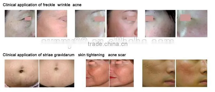 Chinese professional scanner co2 medical laser fractional laser