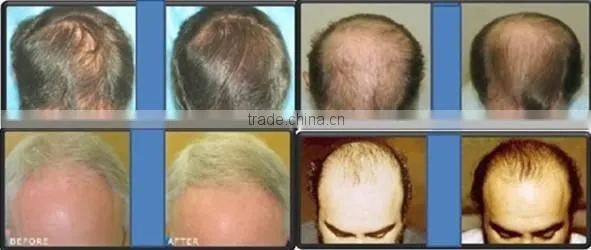 PDT laser hair growth /best hair loss treatment machine