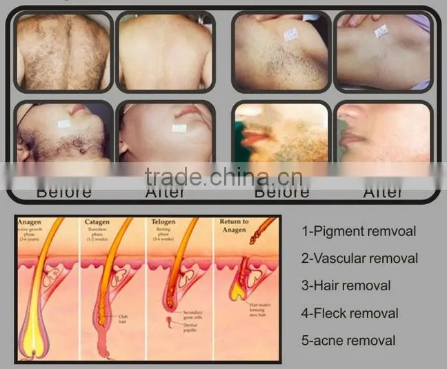 2015 factory promotion!!!!!!! Permanent opt hair removal ipl shr ssr machine