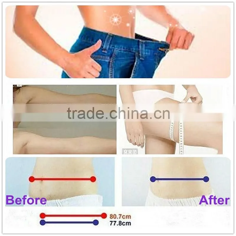 HIFU ultrasonic slimming machine for body shaping and reducing striae of pregnancy