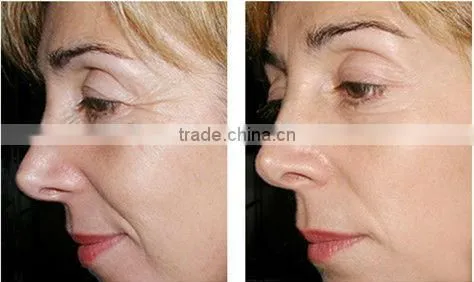 High power professional ipl photo rejuvenation machine