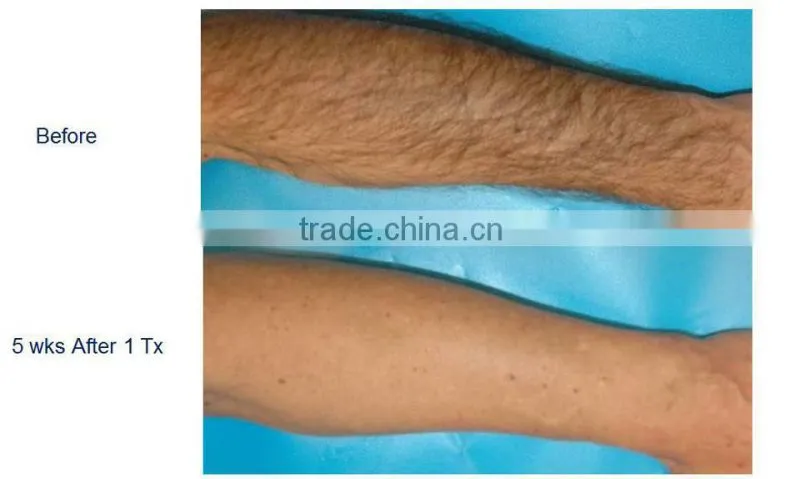 Hot selling!! Multifunctional ipl nd yag laser hair removal/tattoo removal