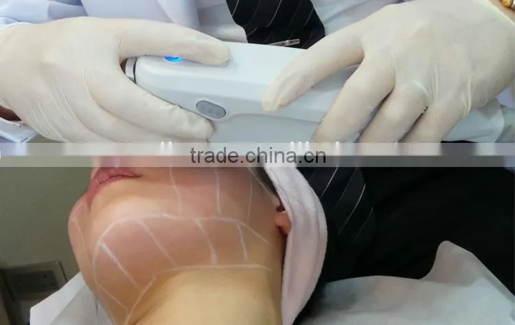 High Intensity Focus Ultrasound HIFU for Face and Neck Lift Without Surgery