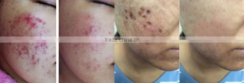 medical co2 laser therapy skin cooling equipment