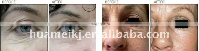 super ipl hair removal beauty machine for beauty salon