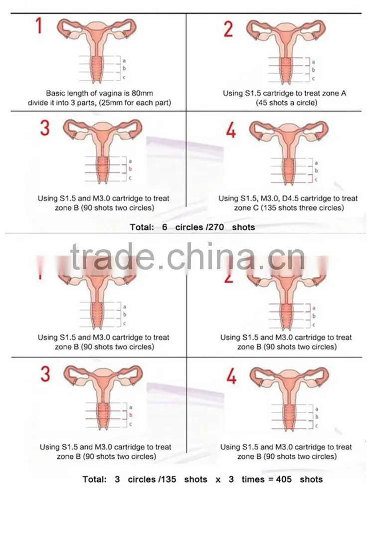 2016 Good effect 25mm focal length hifu vaginal tightening machine with CE certificate