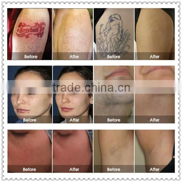 3 in 1 elight ipl nd yag laser rf machine