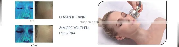 Amb-Master Race best selling skin rejuvenation equipment(CE,ISO13485)