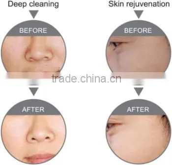 water aqua jet peeling facial dermabrasion super crystal skin care spray machine