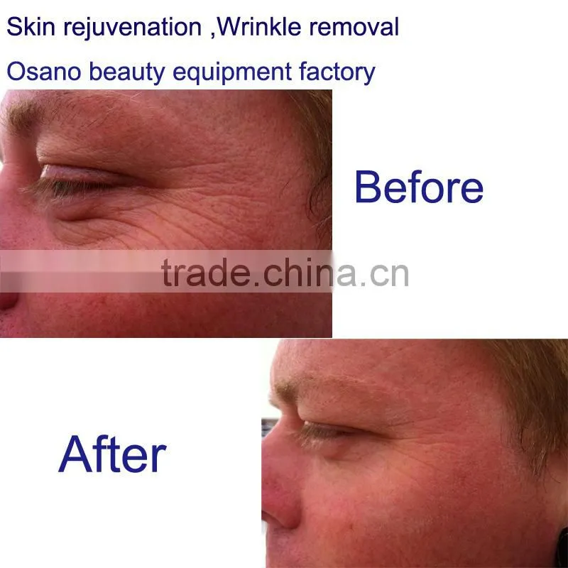 Distribution opportunity rf galvanic spa device