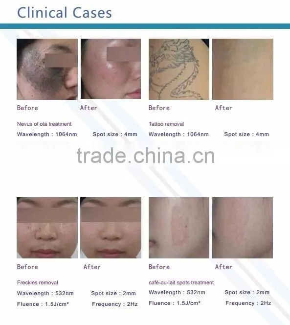 Q-switch 1000W big spot Nd Yag Laser for tattoo pigment remaoval FDA approved