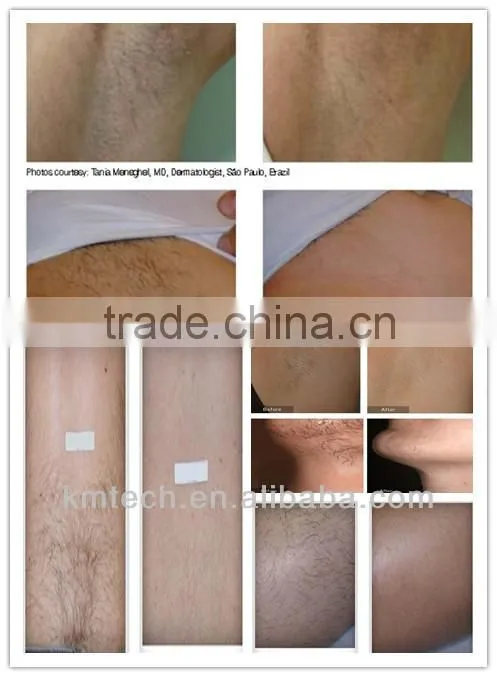 Best fda approved laser hair removal machine for sale