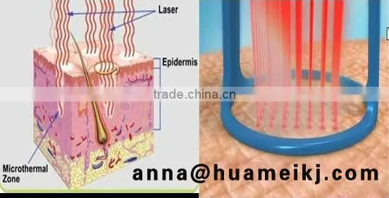 CO2 Fractional laser laser resurfacing machine
