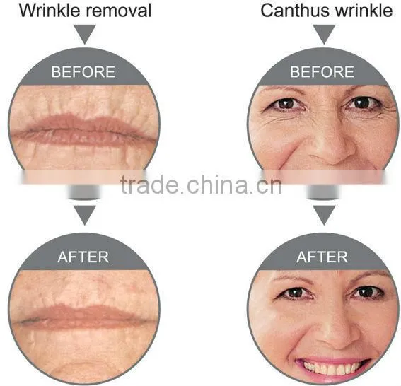 High performance chinese Multifunctional beauty machine
