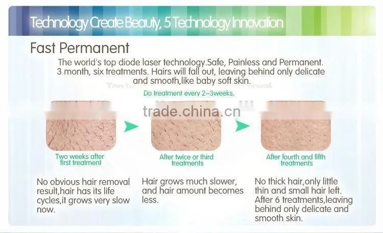 zhengjia medical mini 808nm diode laser hair removal , tria lazer epilasyon