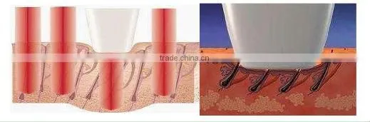 2000W 2000W 808nm diode laser with 5 cool systems