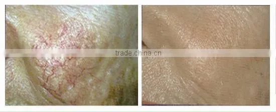 Promotion! most advanced spider vein