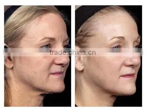 dermapen needles/electric hot sale 12 needls dermapen
