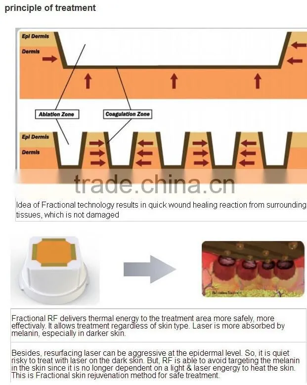 high preformance portable fractional wrinkle removal microneedle rf machine price for clinic hospital beauty spa
