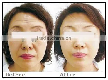 Hotsale thermagic rf for wrinkle removal